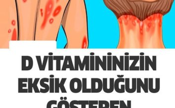 D Vitamini Eksikliğiniz Olduğunu Gösteren 10 Belirgin İşaret