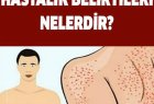 Yağlı Karaciğer Hastalığı Belirtileri
