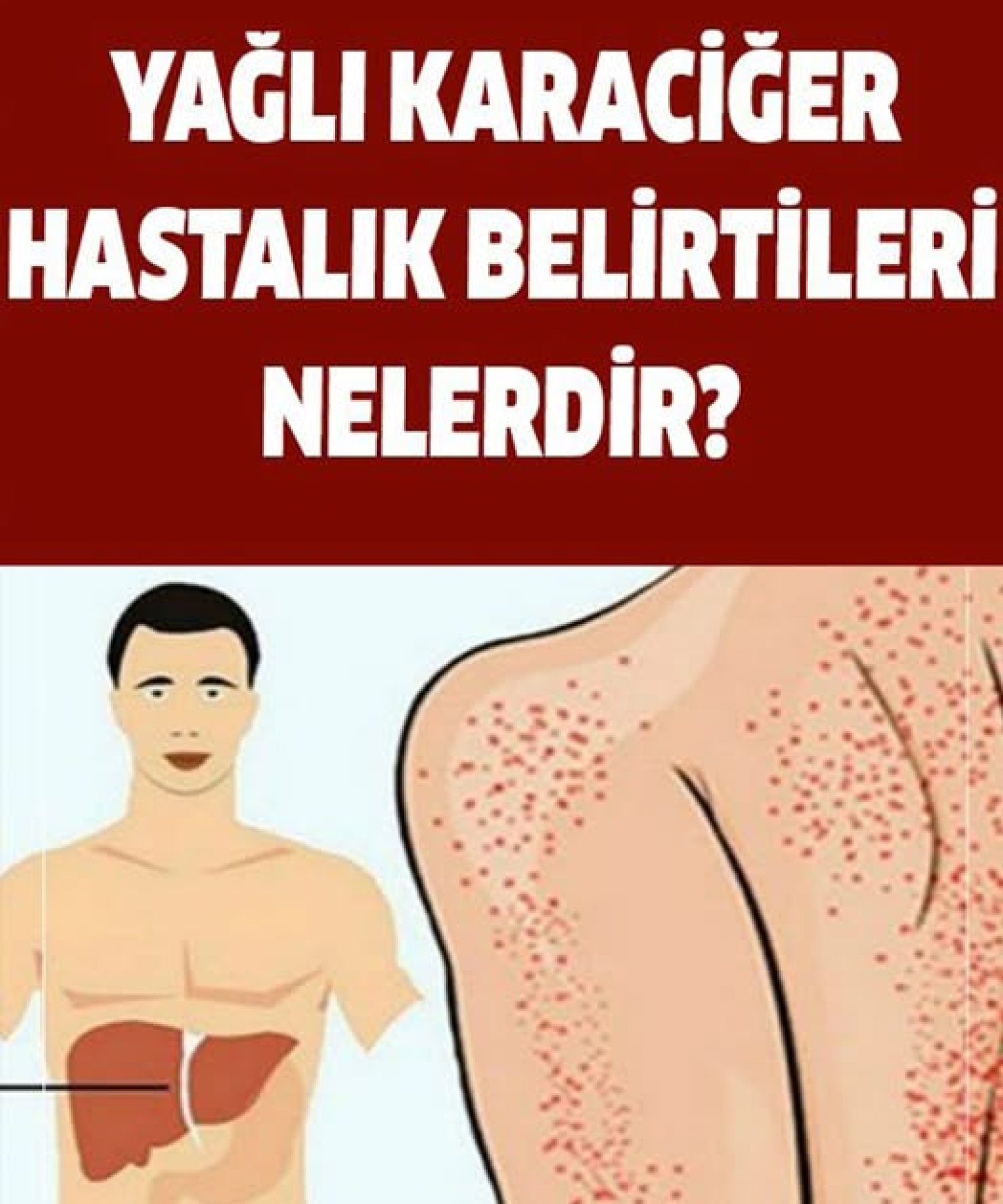 Yağlı Karaciğer Hastalığı Belirtileri