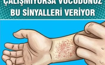 Böbreklerinizin Düzgün Çalışmadığını Gösteren Belirtiler