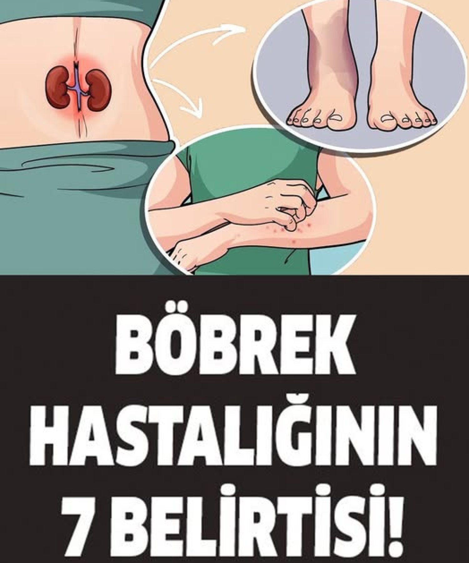 Böbrek Hastalığının 7 Belirtisi