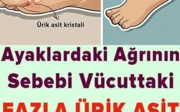 Ayaklardaki Ağrının Sebebi Ürik Asit Olabilir