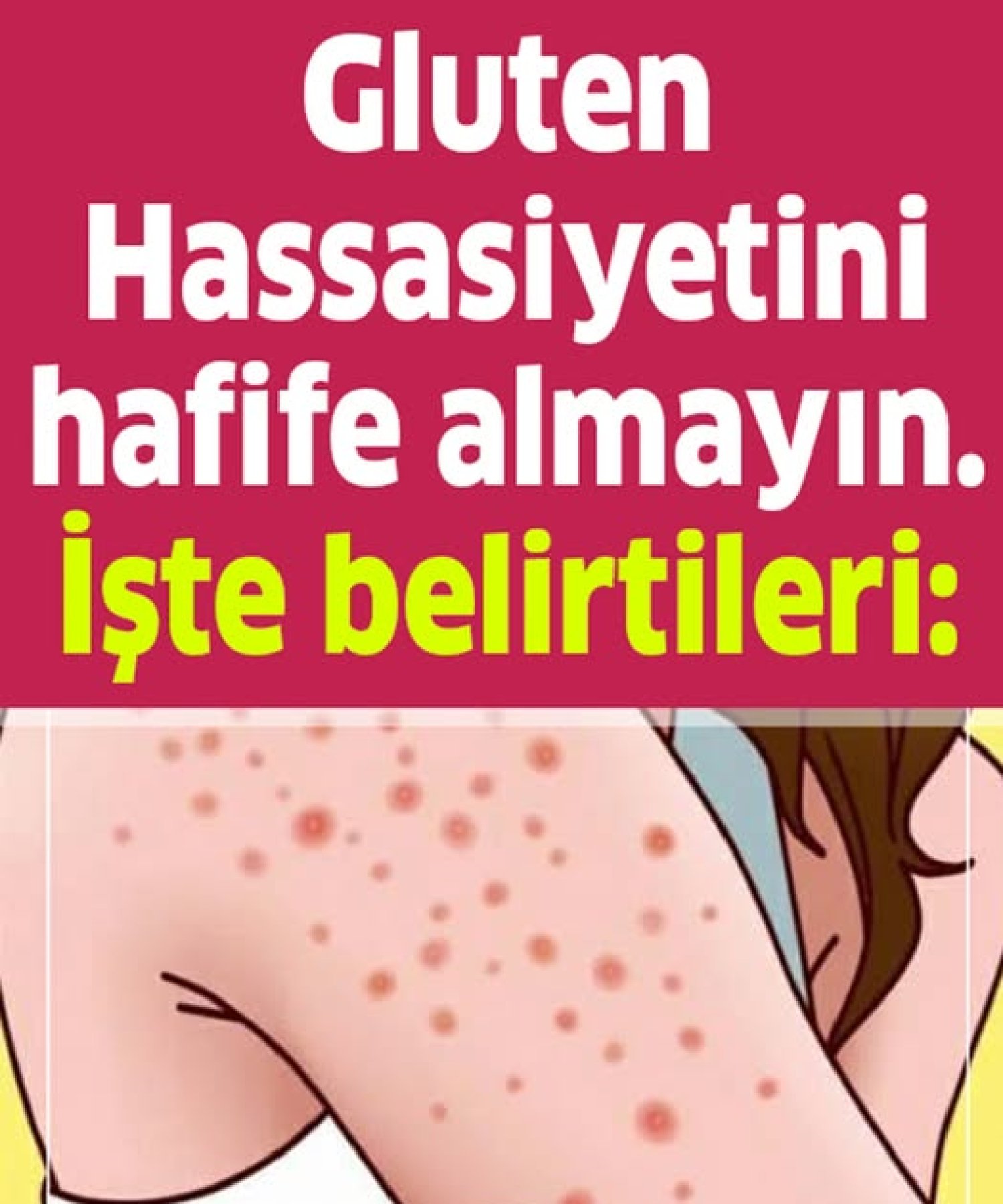 Gluten Hassasiyetini Hafife Almayın İşte Belirtileri