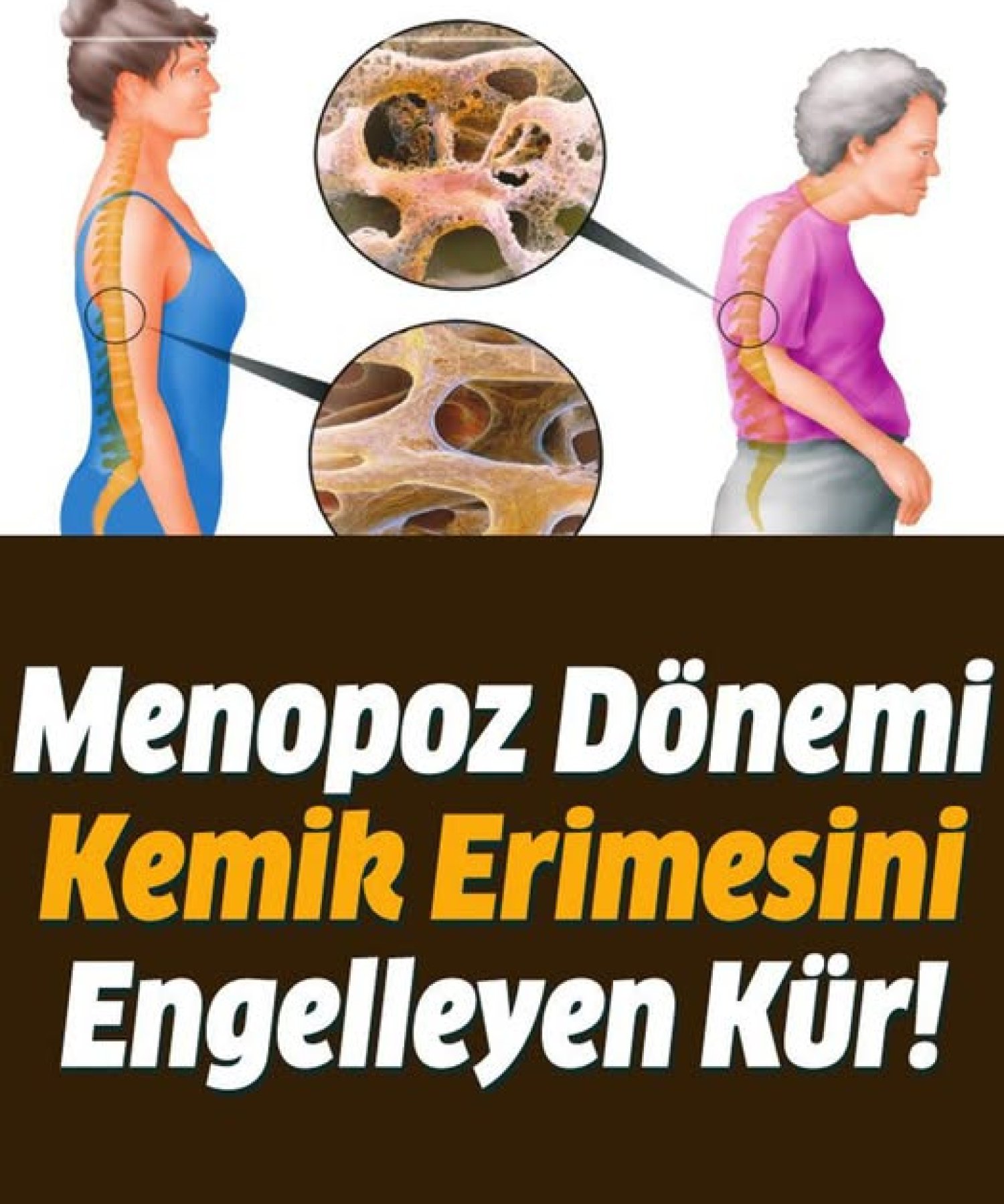Menopoz Dönemi Kemik Erimesini Engelleyen Kür