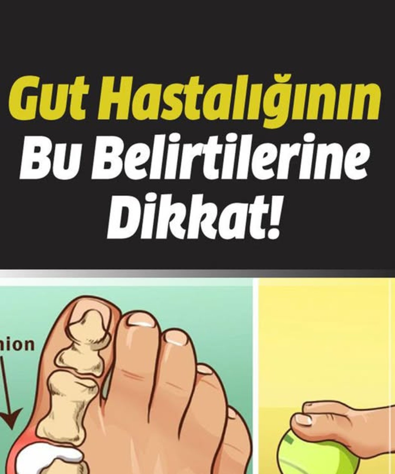 Gut Hastalığının Belirtilerine Dikkat