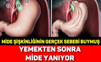 Yemekten Sonra Mide Şişiyorsa