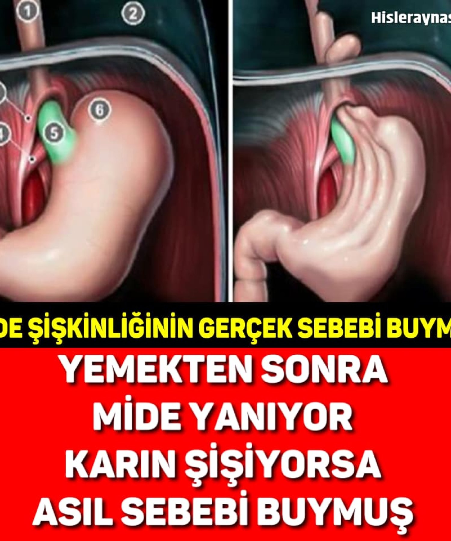 Yemekten Sonra Mide Şişiyorsa