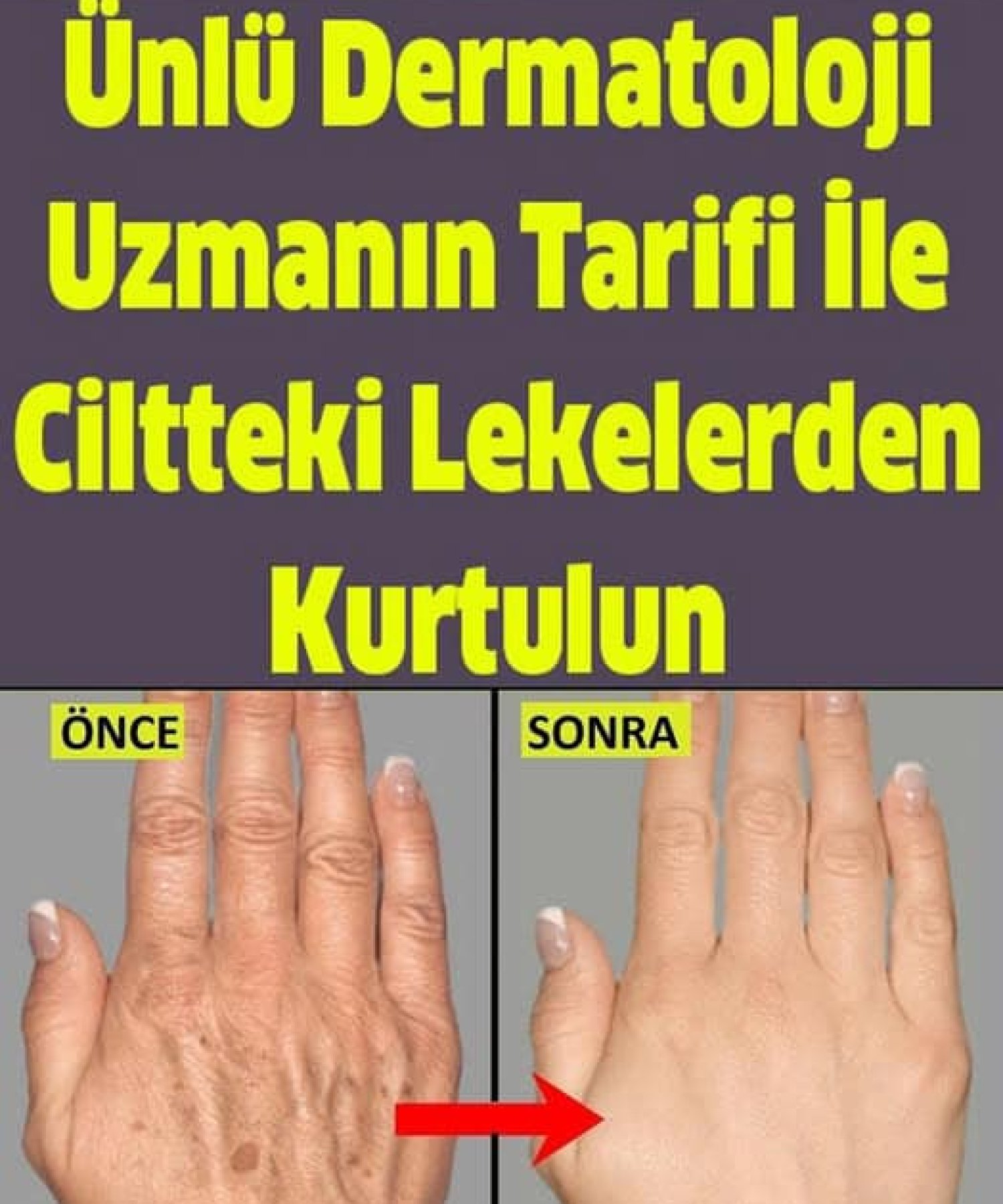 Ünlü Dermatoloji Uzmanın Tarifi İle Ciltteki Lekelerden Kurtulun