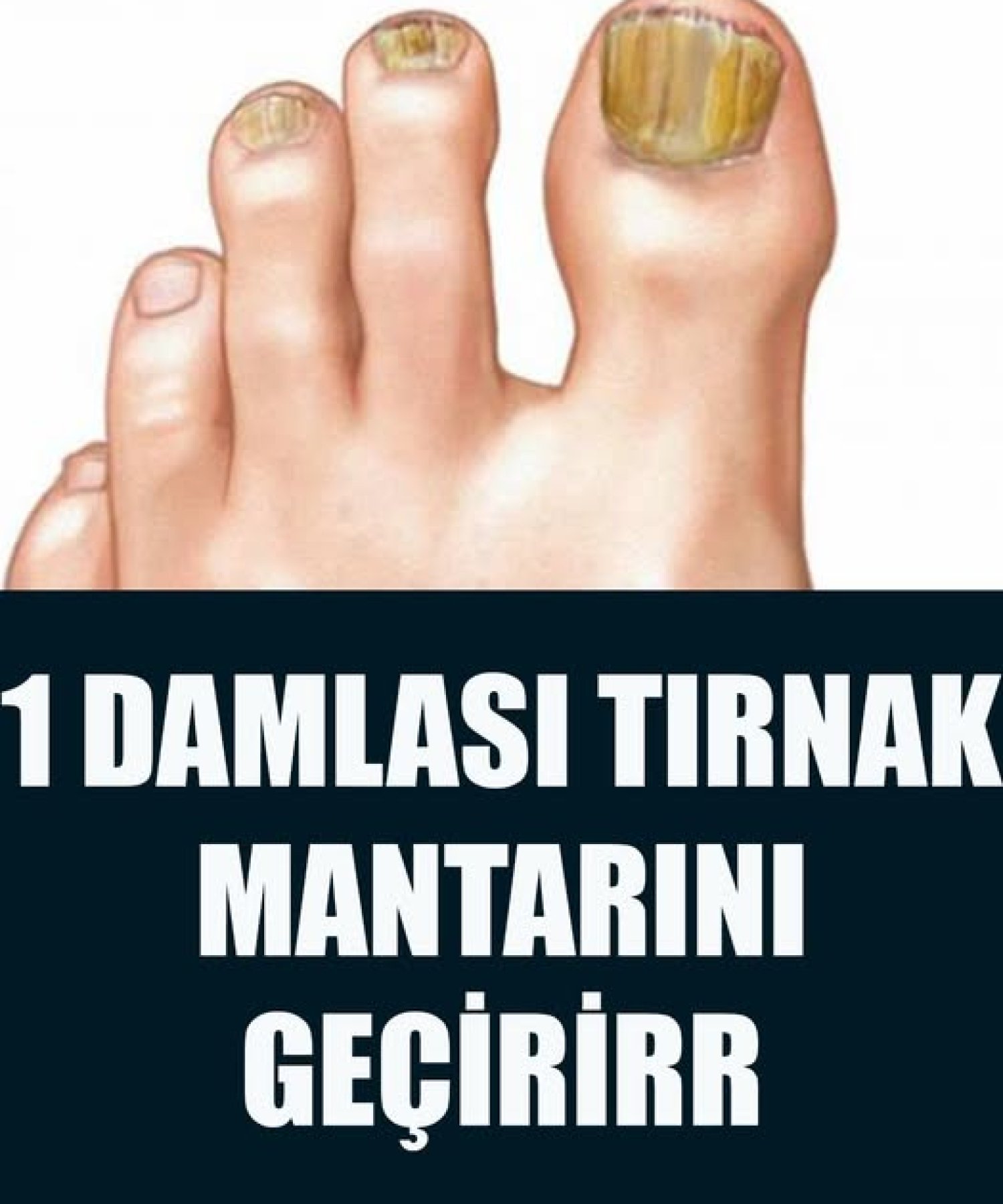 Basit Bir Yöntemle Tırnak Mantarından Kurtulun