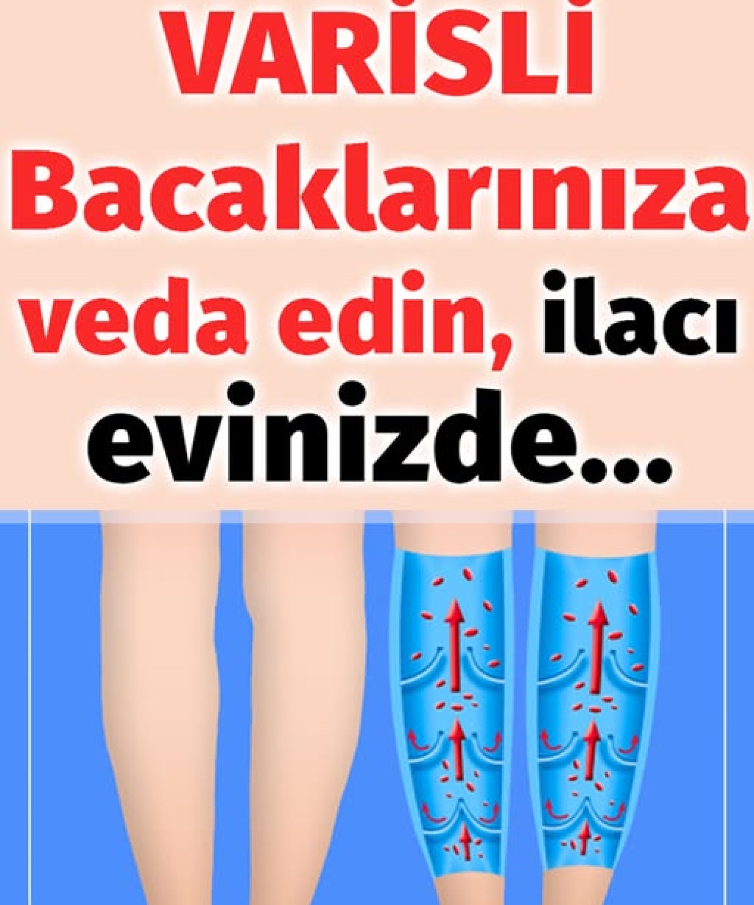Varisli Damarlardan Kurtulmak İçin Doğal Çözümler
