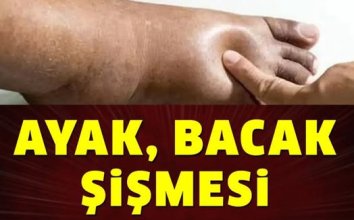 Ayak Bacak Şişmesi Neyin Belirtisi