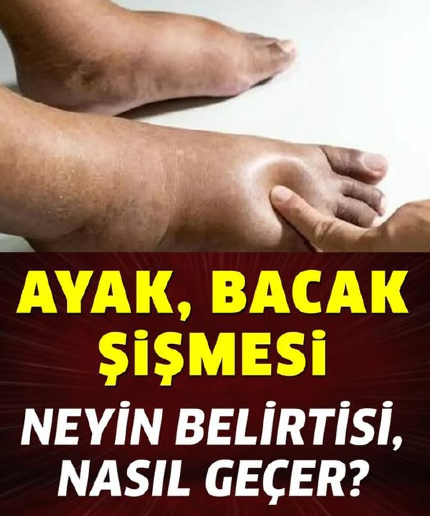 Ayak Bacak Şişmesi Neyin Belirtisi